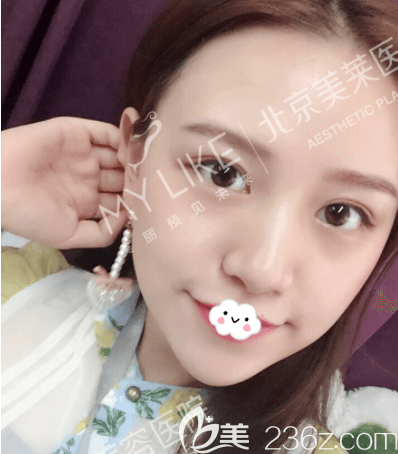 周福田医生给我做玻尿酸垫下巴第7天效果 周福田医生给我做玻尿酸垫下巴第7天效果