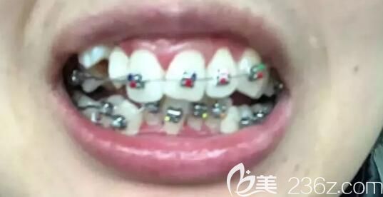 我在北京维嘉口腔刚戴牙套 我在北京维嘉口腔刚戴牙套