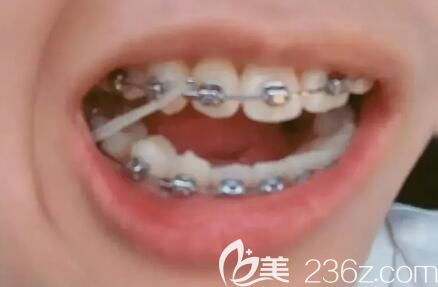 我在北京维嘉口腔做牙齿矫正1年效果 我在北京维嘉口腔做牙齿矫正1年效果