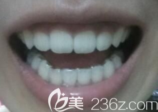 在北京维嘉口腔戴金属牙套矫正虎牙后,不仅牙齿变整齐人也自信了