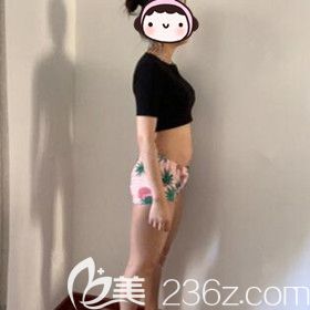 在大连做大腿吸脂术前照 在大连做大腿吸脂术前照