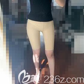 吸脂瘦大腿术后3天 吸脂瘦大腿术后3天