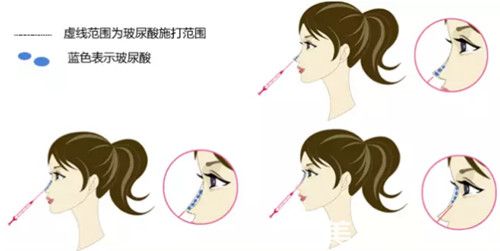 注射玻尿酸隆鼻过程 注射玻尿酸隆鼻过程