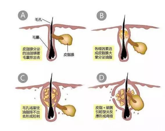 痘痘的形成 痘痘的形成