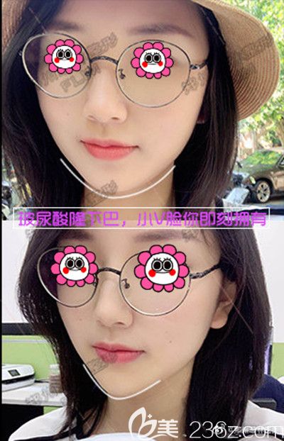 郑州菲林做玻尿酸丰下巴的前后对比 郑州菲林做玻尿酸丰下巴的前后对比