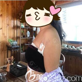 上海华美李健假体隆胸真人案例术后第10天