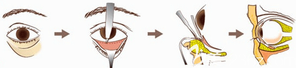 激光祛眼袋过程图