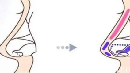 硅胶隆鼻 硅胶隆鼻