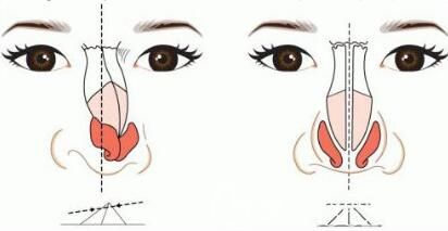 硅胶假体会危害健康吗? 硅胶假体会危害健康吗?