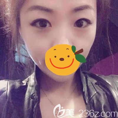 驻马店金玄宫眼综合术前眼睛内双 驻马店金玄宫眼综合术前眼睛内双