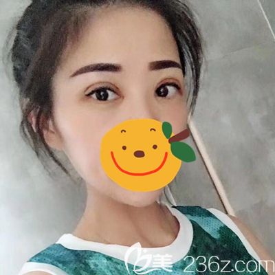 驻马店金玄宫眼综合术后第10天 驻马店金玄宫眼综合术后第10天