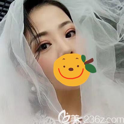 经过了一场在驻马店的眼部综合手术 一个月后我的内双大小眼得到拯救