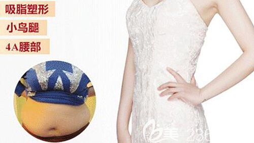 腰腹吸脂术后52天恢复效果变A4腰