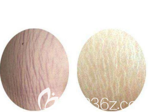 白色和红色的妊娠纹