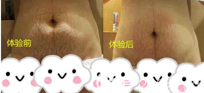 祛除妊娠纹的前后对比照片