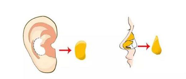 自体耳软骨隆鼻