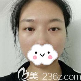 做双眼皮术前照 做双眼皮术前照