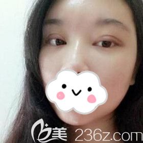 在怀化割双眼皮术后10天恢复<span style= 在怀化割双眼皮术后10天恢复<span style=