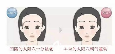 太阳穴凹陷和饱满的区别