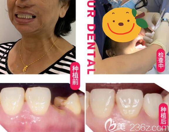 真人案例效果来验证下美奥口腔好不好