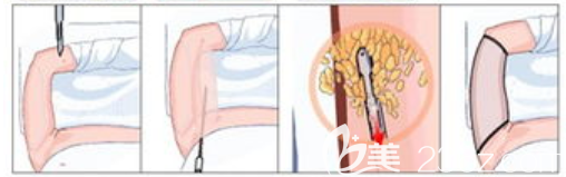 手臂抽脂过程图