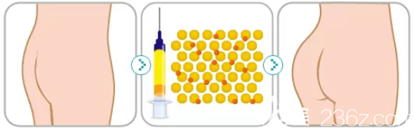 自体脂肪丰臀图解