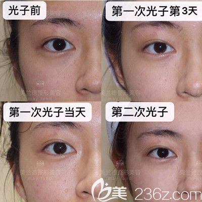 驻马店美兰德整形光子嫩肤真人案例 驻马店美兰德整形光子嫩肤真人案例