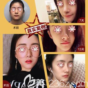 项利姣院长做自体脂肪面部填充移植术前术后效果对比