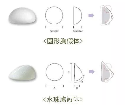 圆形,水滴形胸假体形状示意图