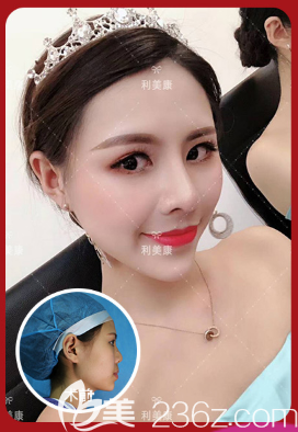 遵义利美康隆鼻案例 遵义利美康隆鼻案例