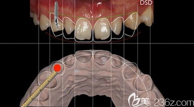 李小霞优势项目DSD微笑设计 李小霞优势项目DSD微笑设计