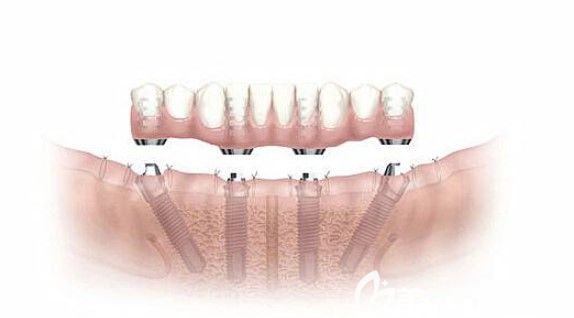 刘靖医生特色种植牙项目ALL-ON-4 刘靖医生特色种植牙项目ALL-ON-4