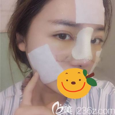 洛阳毛大夫鼻综合术后1天