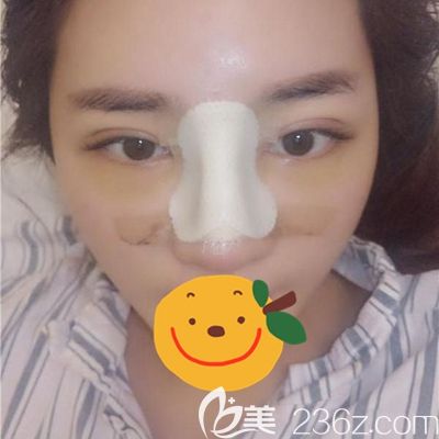 毛大夫鼻综合术后3天