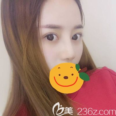 洛阳毛大夫隆鼻术后30天效果