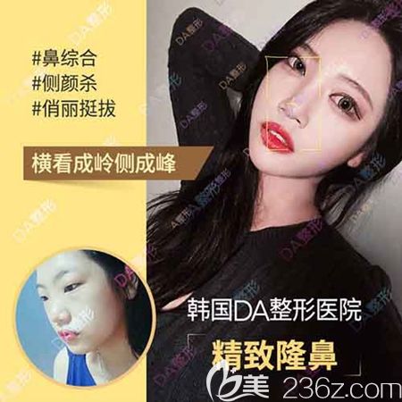 韩国DA整形外科鼻部整形优惠 韩国DA整形外科鼻部整形优惠