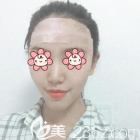 自体脂肪填充额头术后第2天