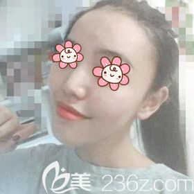 做自体脂肪填充额头术后9天恢复<span style=