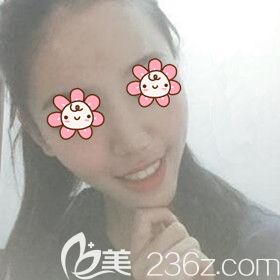 在湘潭雅美做自体脂肪填充额头术后15天<span style=