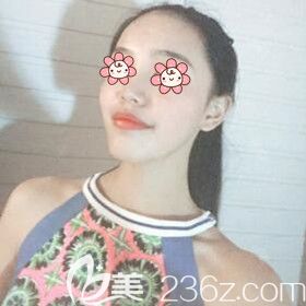 做完自体脂肪填充面部术后30天<span style=