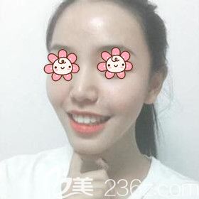 把我在湘潭雅美做自体脂肪丰额头太阳穴术后45天恢复效果图跟大家分享一下！