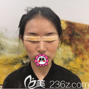宁波艺星做双眼皮术后即刻