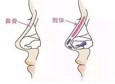 隆鼻假体植入的层次