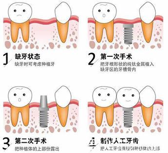 种植牙手术过程图解