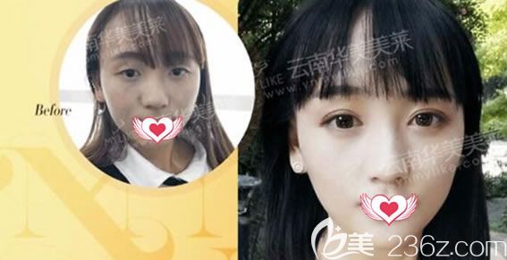 做韩式全切双眼皮效果