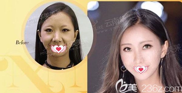 华美美莱宋萍注射效果对比图