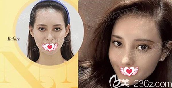 李大铁全脸注射玻尿酸效果对比图