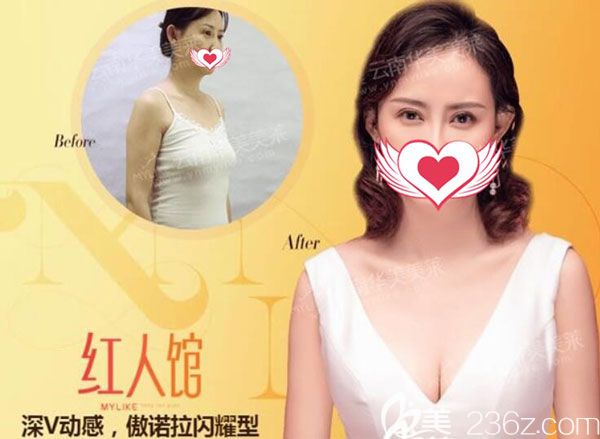 夏兴国做假体隆胸效果对比图