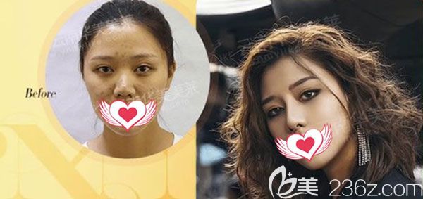 美莱整形杨继红做鼻综合效果对比图