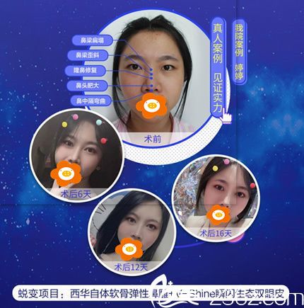 林晓雄自体软骨隆鼻+V—Shine瞬闪双眼皮前后照片 林晓雄自体软骨隆鼻+V—Shine瞬闪双眼皮前后照片